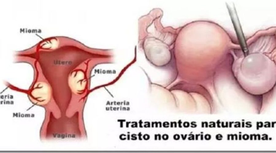 Estes S O Os Melhores Rem Dios Naturais Para Eliminar Miomas E Cistos